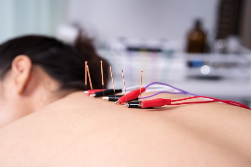 acupuntura neurofuncional