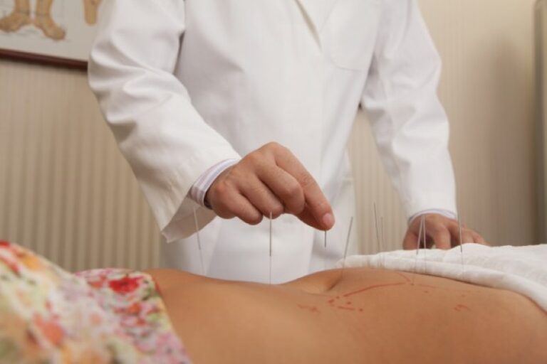 acupuntura