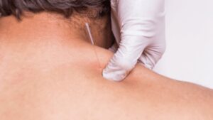 Dry Needling