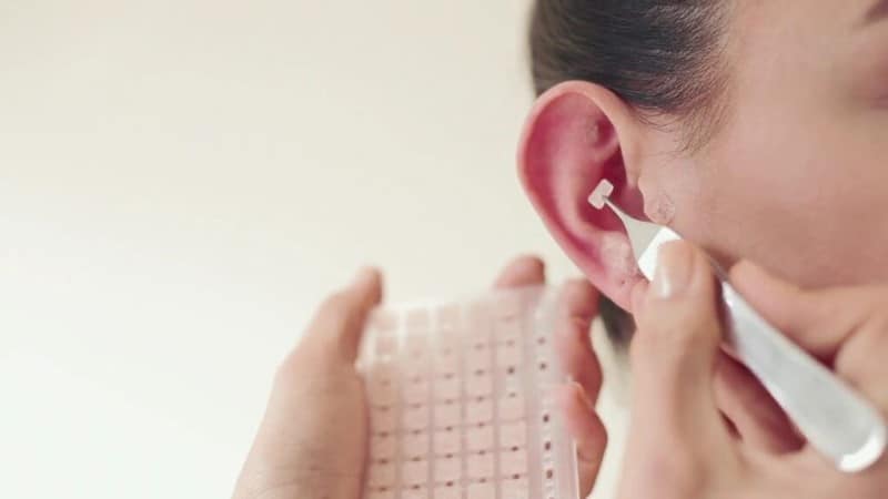 auriculoterapia